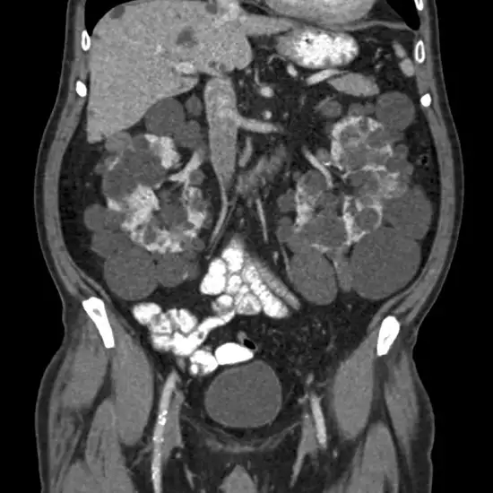 CECT Whole Abdomen With Urography